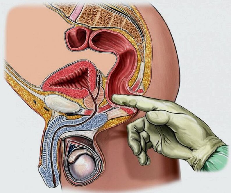 Prostatamassage bei Prostatitis