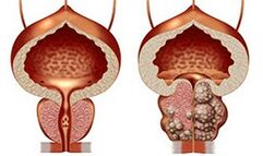 Gesunde und ungesunde Prostata
